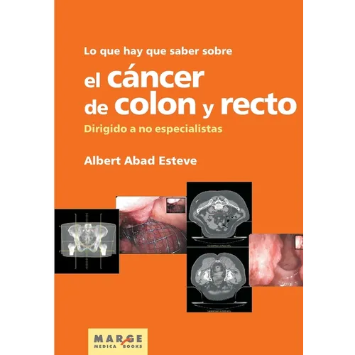 Lo que hay que saber sobre el cáncer de colon y recto