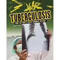 Tuberculosis: How the White Death Changed History
