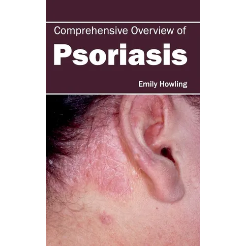 Comprehensive Overview of Psoriasis