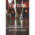 Varices: Síntomas, causas y tratamiento natural