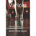 Varices: Síntomas, causas y tratamiento natural