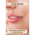 Stop Moles: Removing Large Moles From The Face: Surefire Way To Get Rid Of Moles