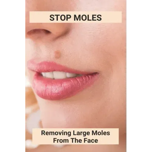 Stop Moles: Removing Large Moles From The Face: Surefire Way To Get Rid Of Moles