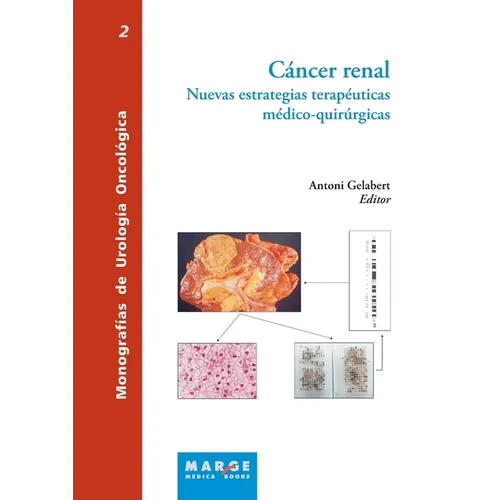 Cáncer renal: Nuevas estrategias terapéuticas médico-quirúrgicas
