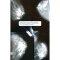 The Biopolitics of Breast Cancer: Changing Cultures of Disease and Activism