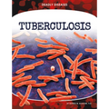 Tuberculosis