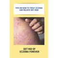 Tips On How To Treat Eczema And Relieve Dry Skin: Get Rid Of Eczema Forever: Overcome Eczema