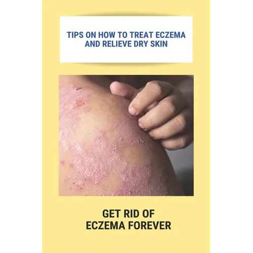 Tips On How To Treat Eczema And Relieve Dry Skin: Get Rid Of Eczema Forever: Overcome Eczema