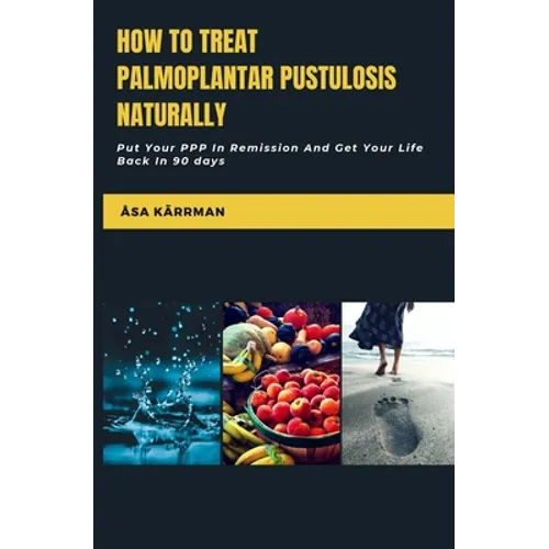 How To Treat Palmoplantar Pustulosis Naturally: Put Your PPP In Remission And Get Your Life Back in 90 days