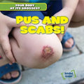 Pus and Scabs!