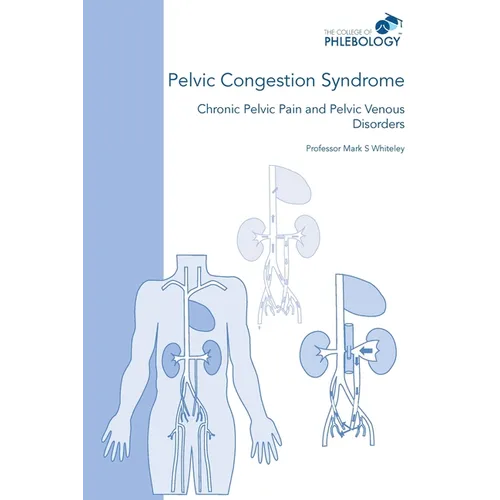 Pelvic Congestion Syndrome - Chronic Pelvic Pain and Pelvic Venous Disorders