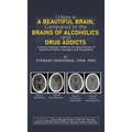 I Have a Beautiful Brain, Compared to the Brains of Alcoholics and Drug Addicts