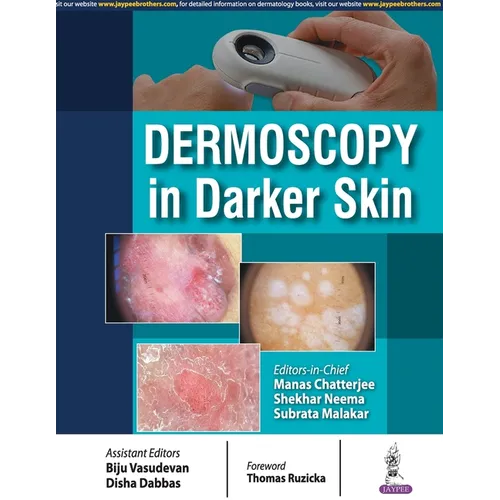 Dermoscopy in Darker Skin