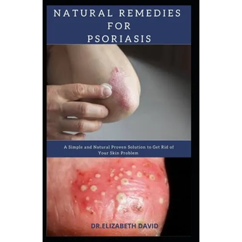 Natural Remedies for Psoriasis: A Simple and Natural Proven Solution to Get Rid of Your Skin Problem: Dermatitis, Eczema, Psoriasis & Rosacea and Othe