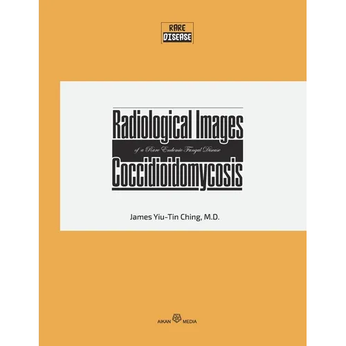 Radiological Images of a Rare Endemic Fungal Disease Coccidioidomycosis