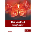 Non-Small Cell Lung Cancer